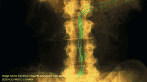 A photo of electrical implants that could help treat some spinal injuries