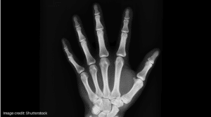 X-ray of a hand