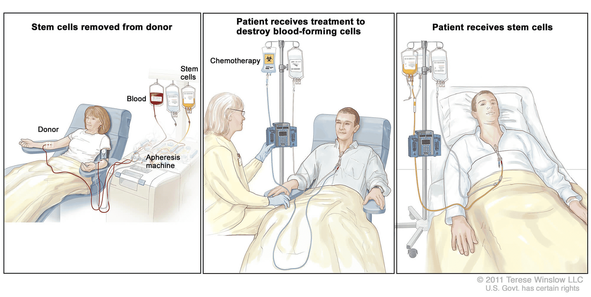 Stem Cell Transplant