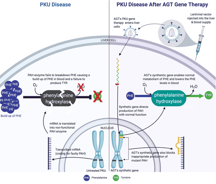AGT PKU PKU gene therapy treatment