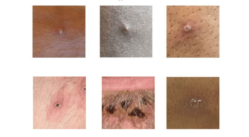 MPimage Monkeypox rashes